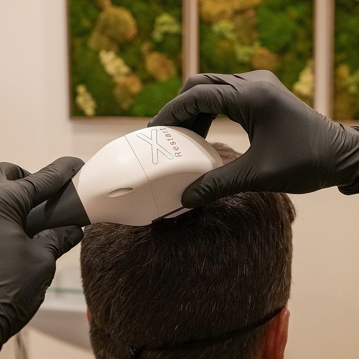 Hair restoration treatment in progress with device.
