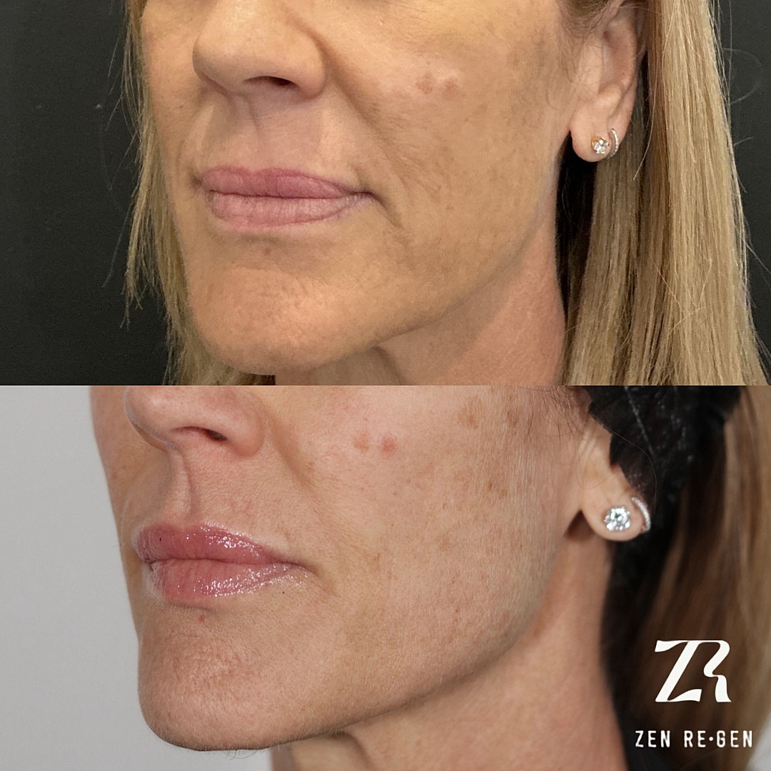 Sculptra Before & After