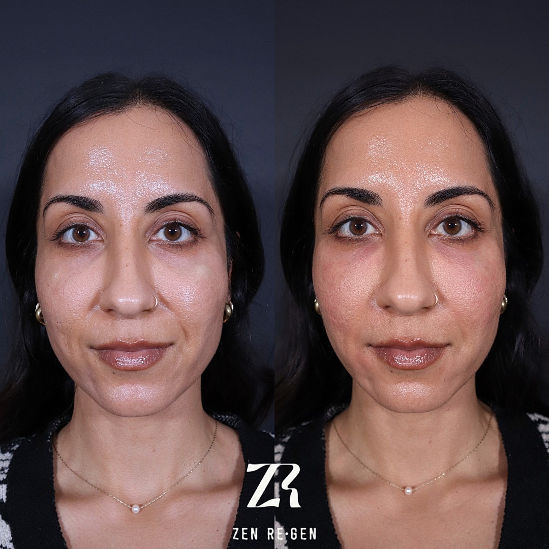 PRP Injections Before & After
