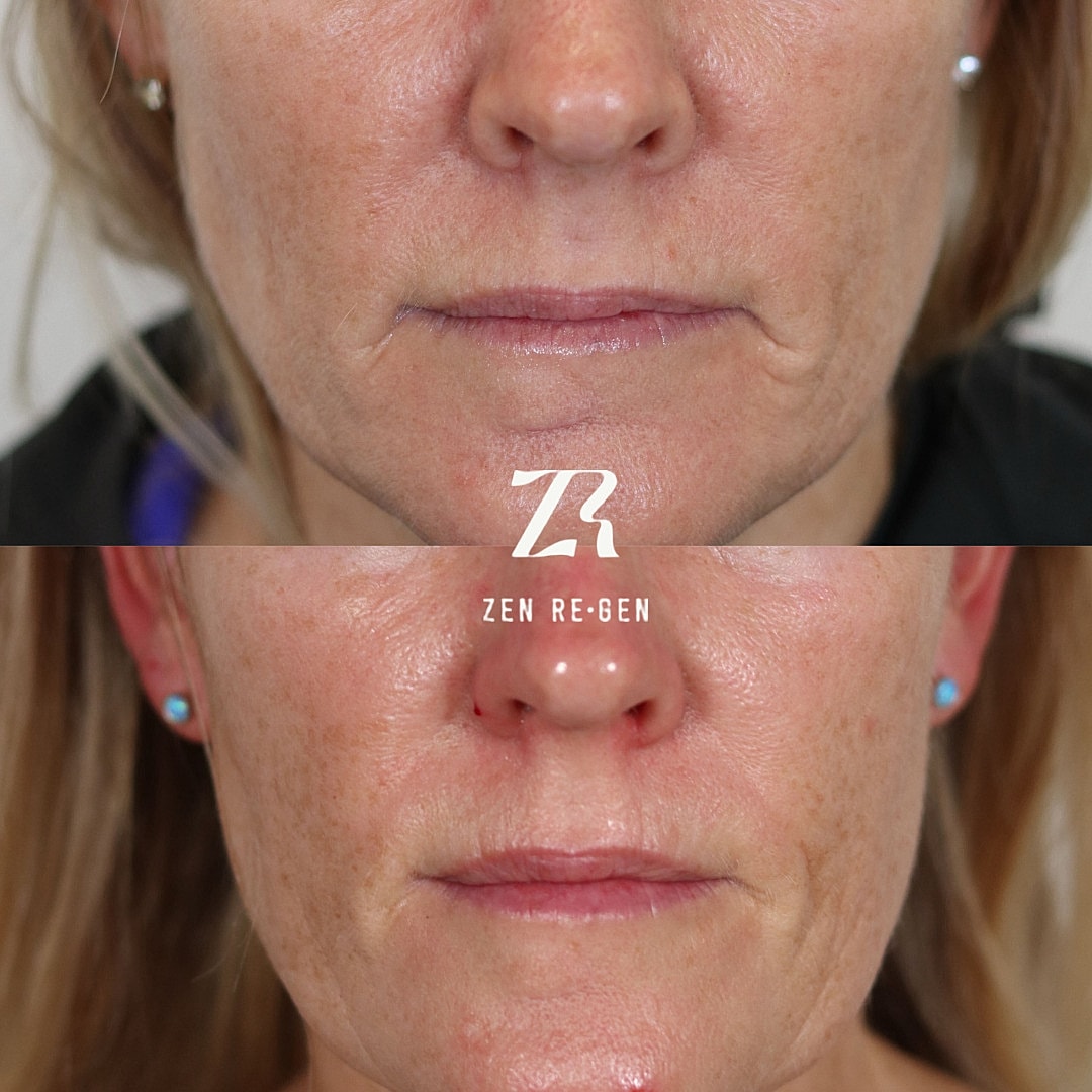 PRP Injections Before & After
