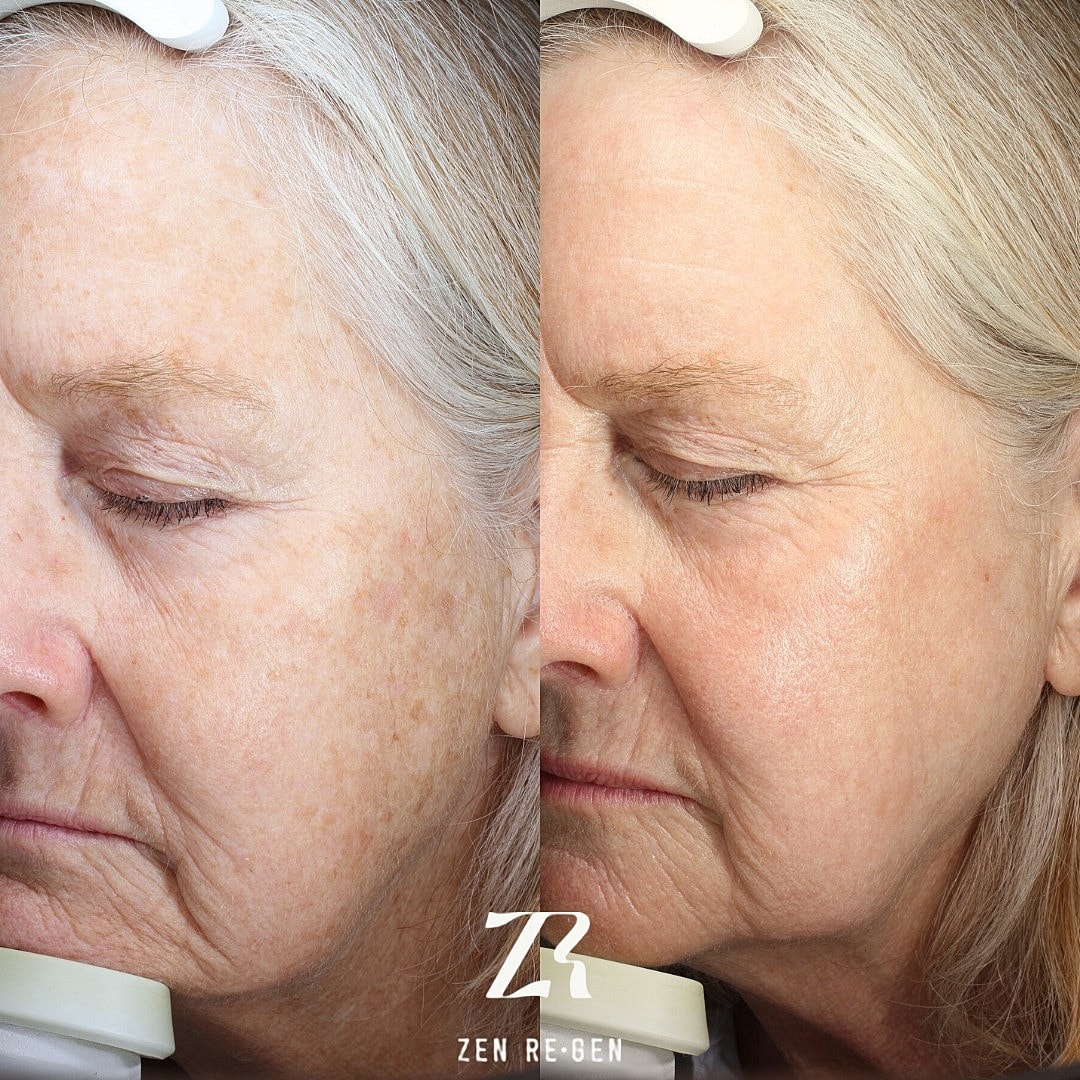 Before and after skin treatment comparison image.