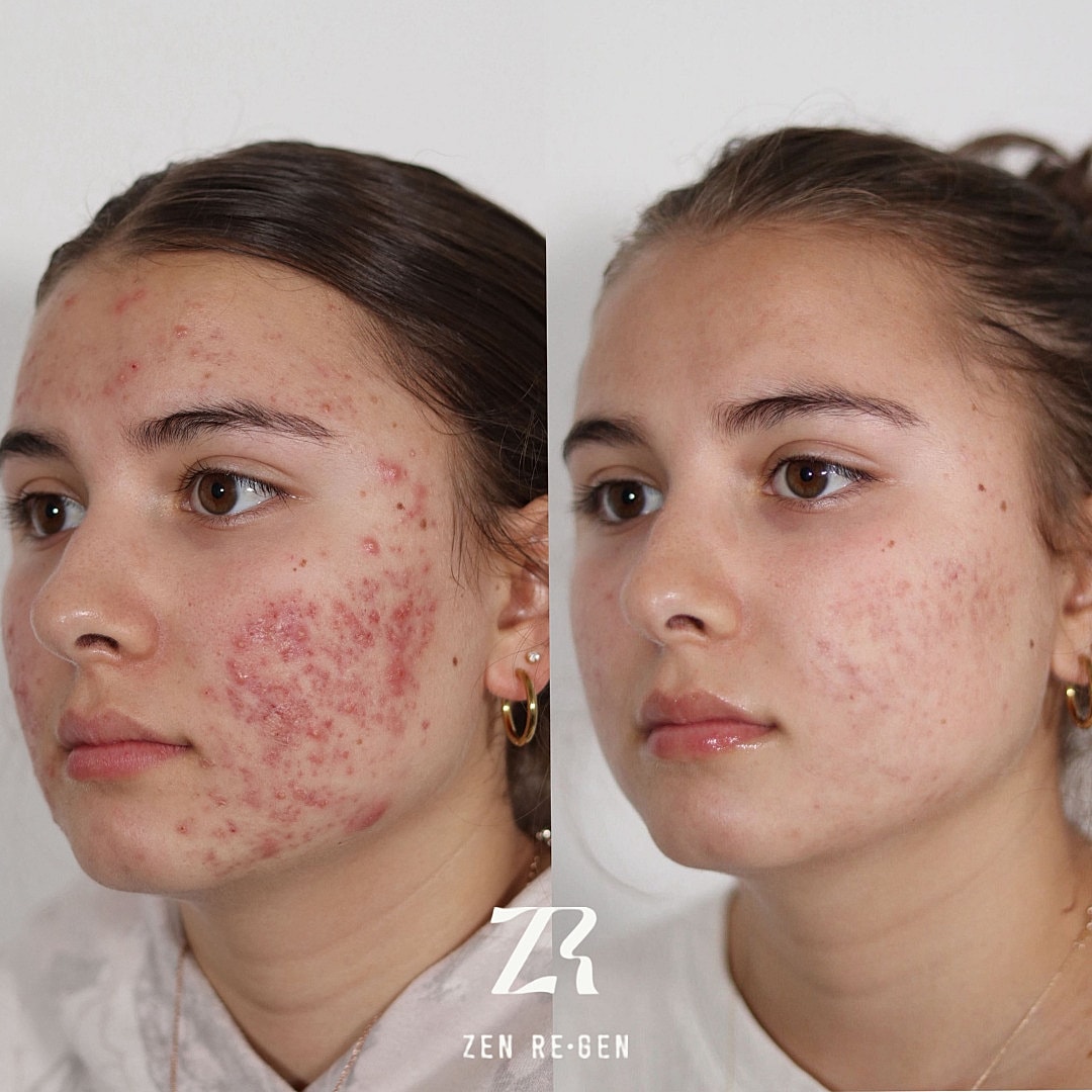 Acne Treatment Before & After