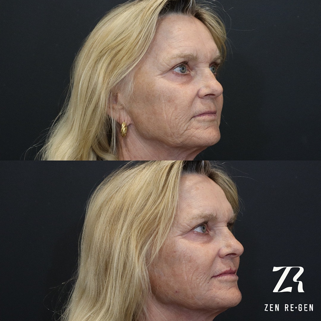 Dermal Filler Before & After