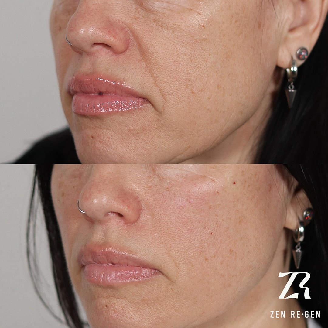 Dermal Filler Before & After