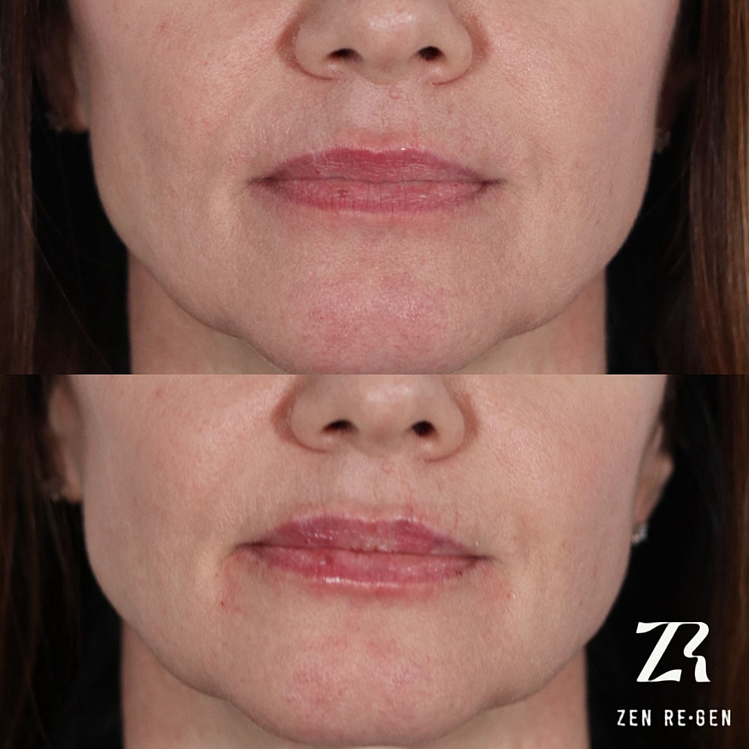 Dermal Filler Before & After