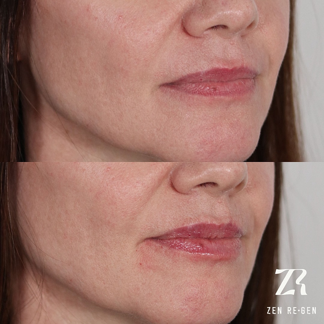 Dermal Filler Before & After