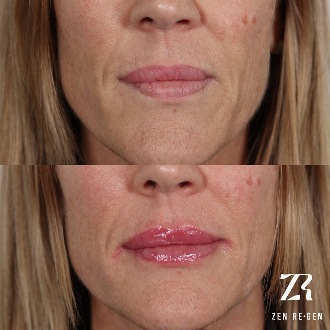Dermal Filler Before & After