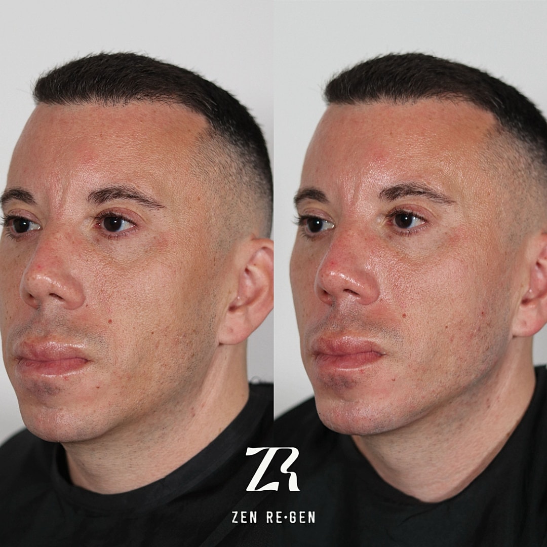Dermal Filler Before & After