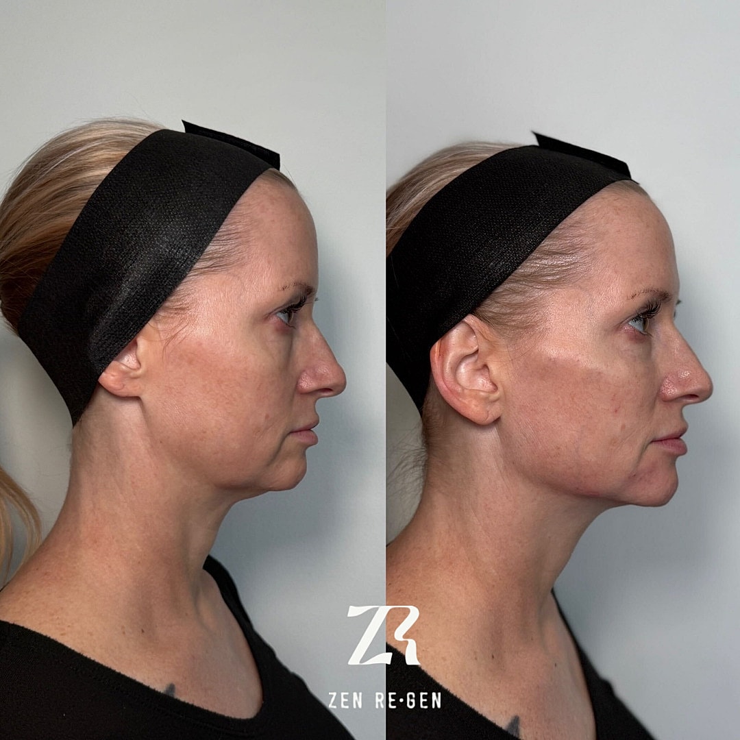Dermal Filler Before & After