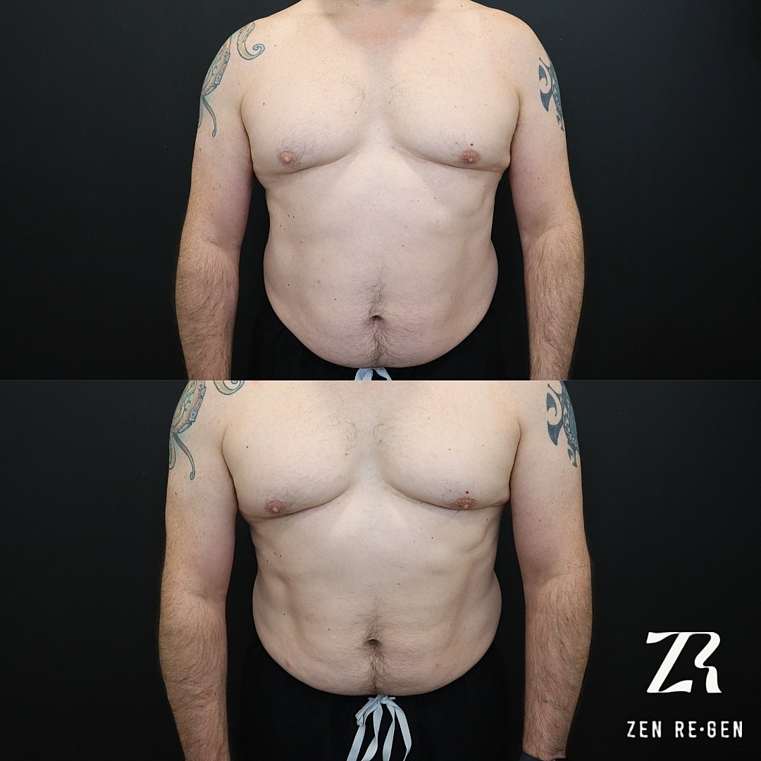 Before and after body transformation progress photo.