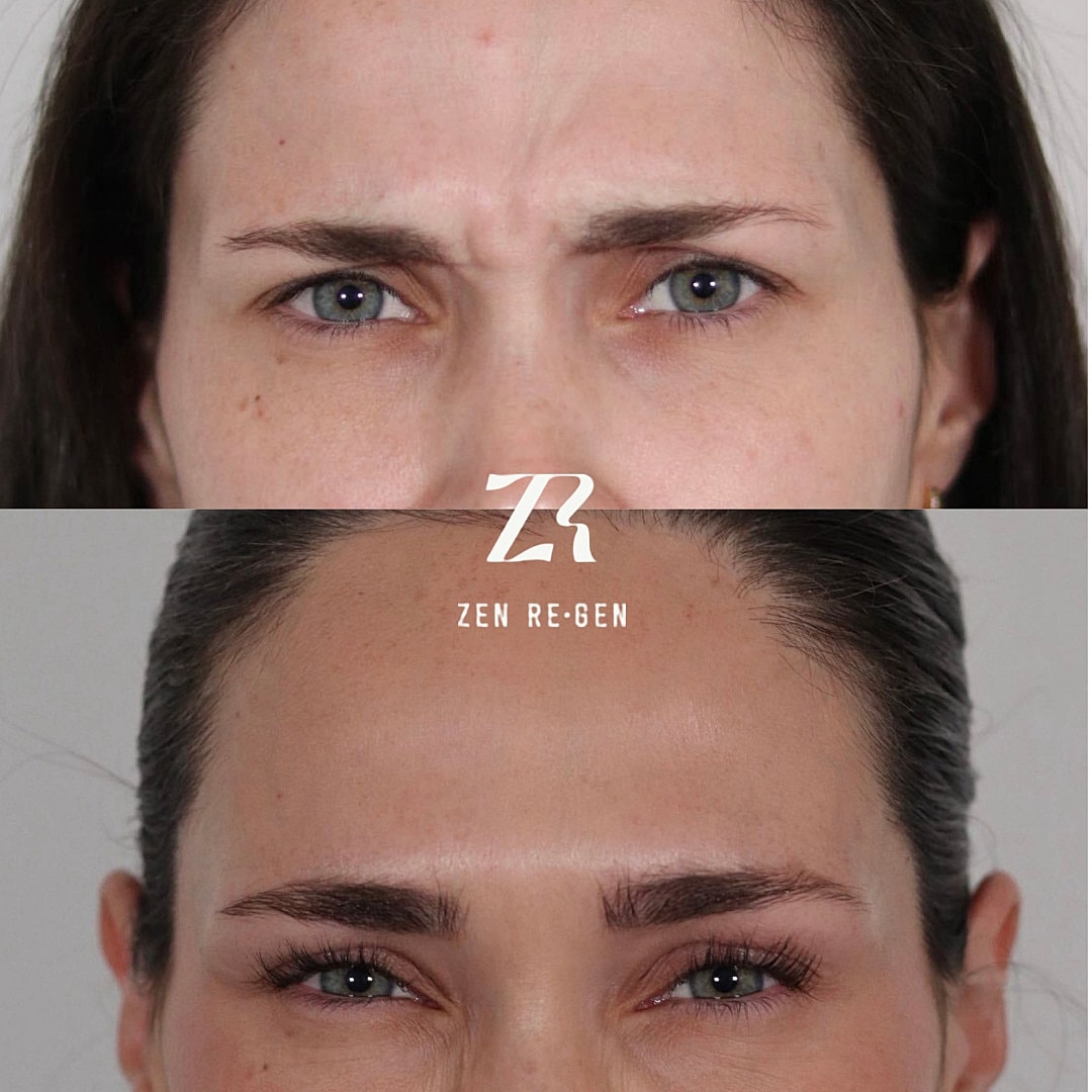 Botox Before & After