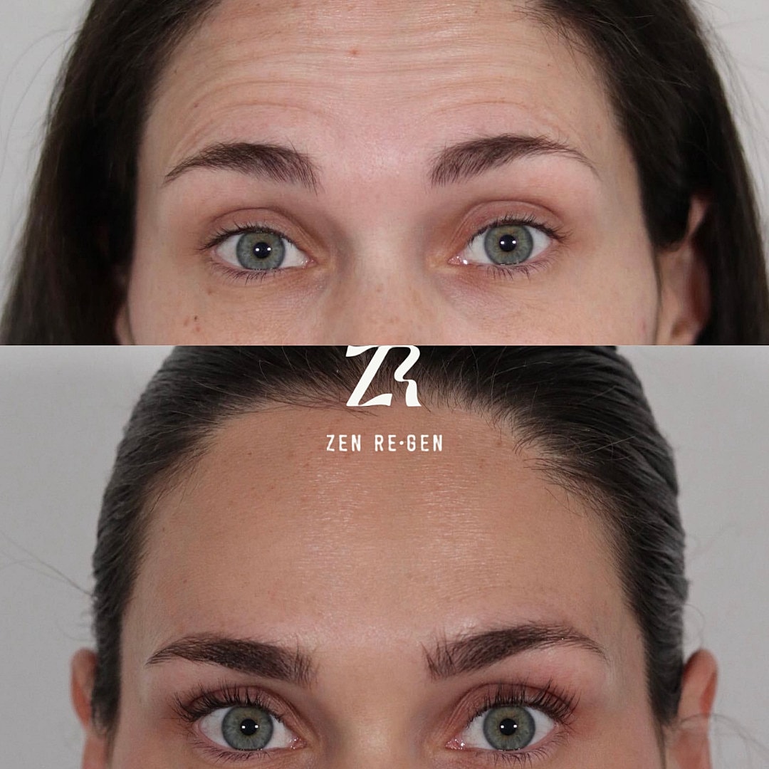 Botox Before & After