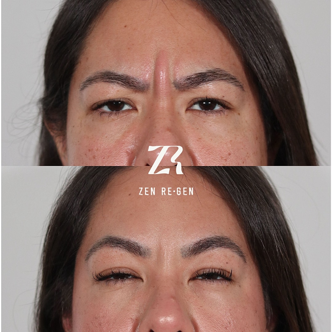 Botox Before & After