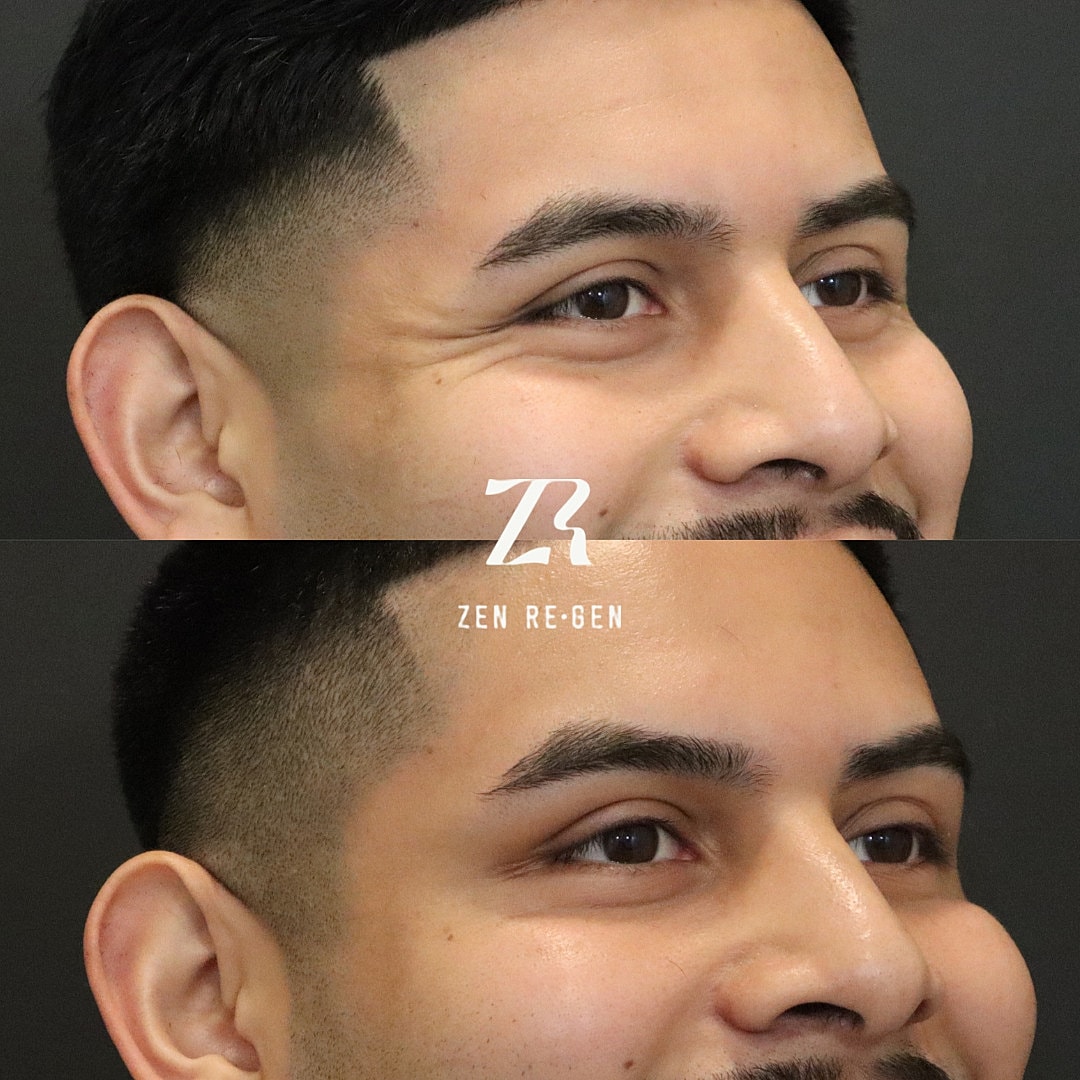 Botox Before & After
