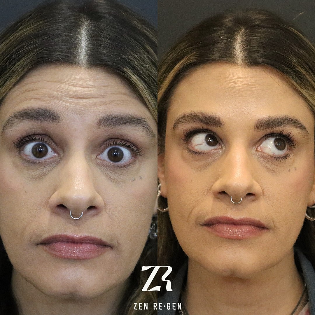 Before and after facial rejuvenation treatment comparison.