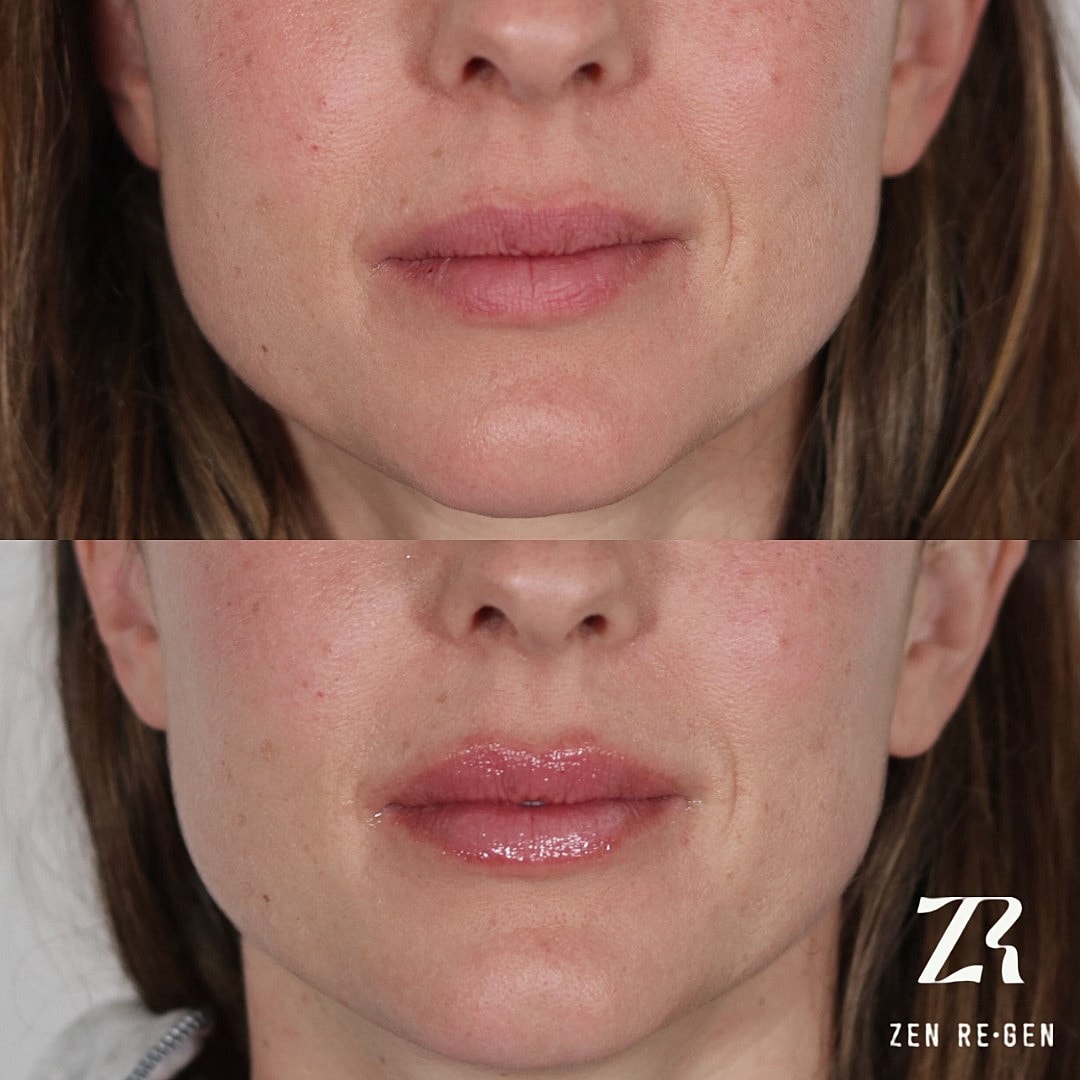 Before and after lip enhancement results