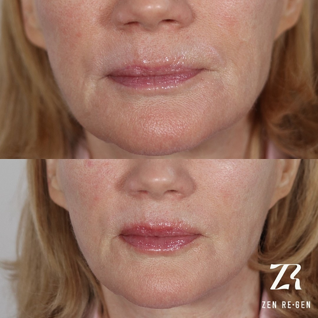 Before and after lip treatment results