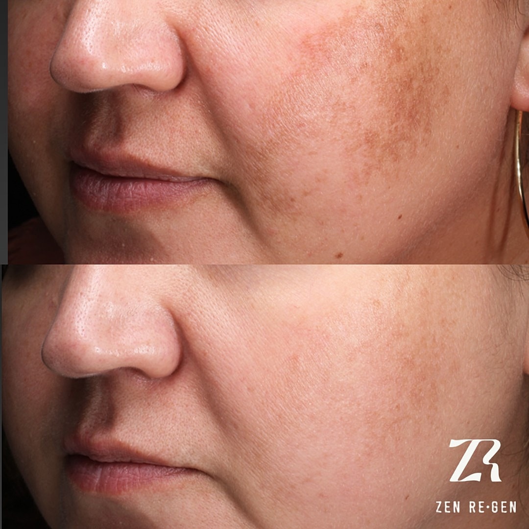 Before and after skin treatment comparison images.