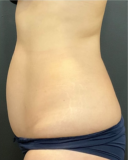 Coolsculpting Before & After