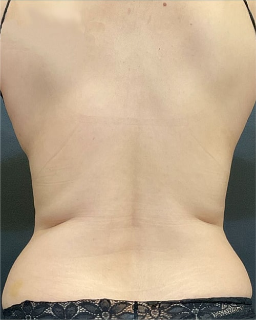 Coolsculpting Before & After