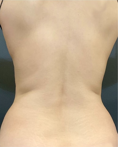 Coolsculpting Before & After