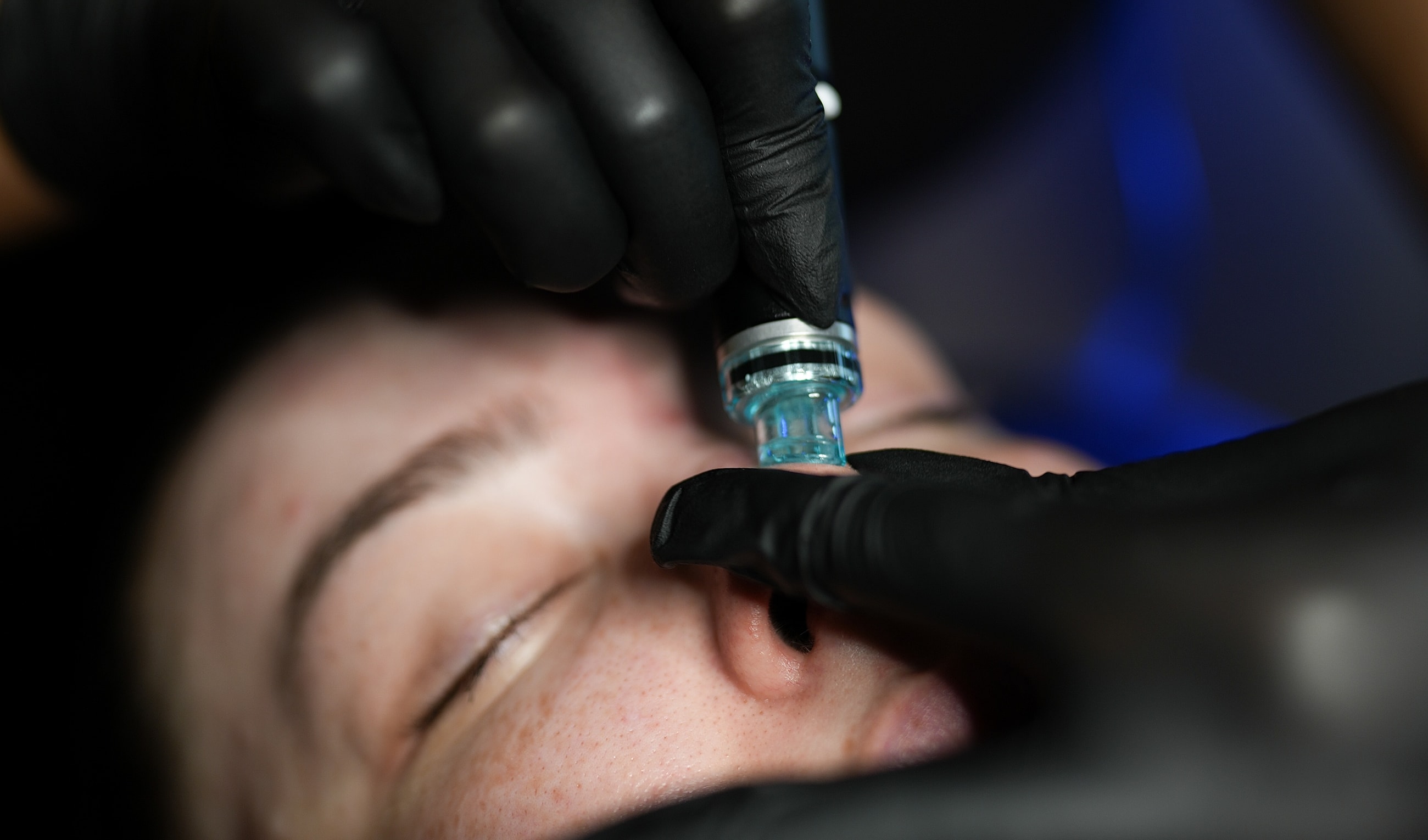 Applying microneedling treatment on a client's face.