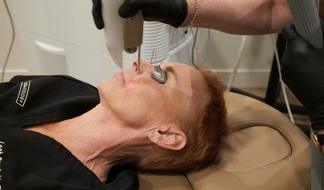 Laser treatment for facial rejuvenation in progress.