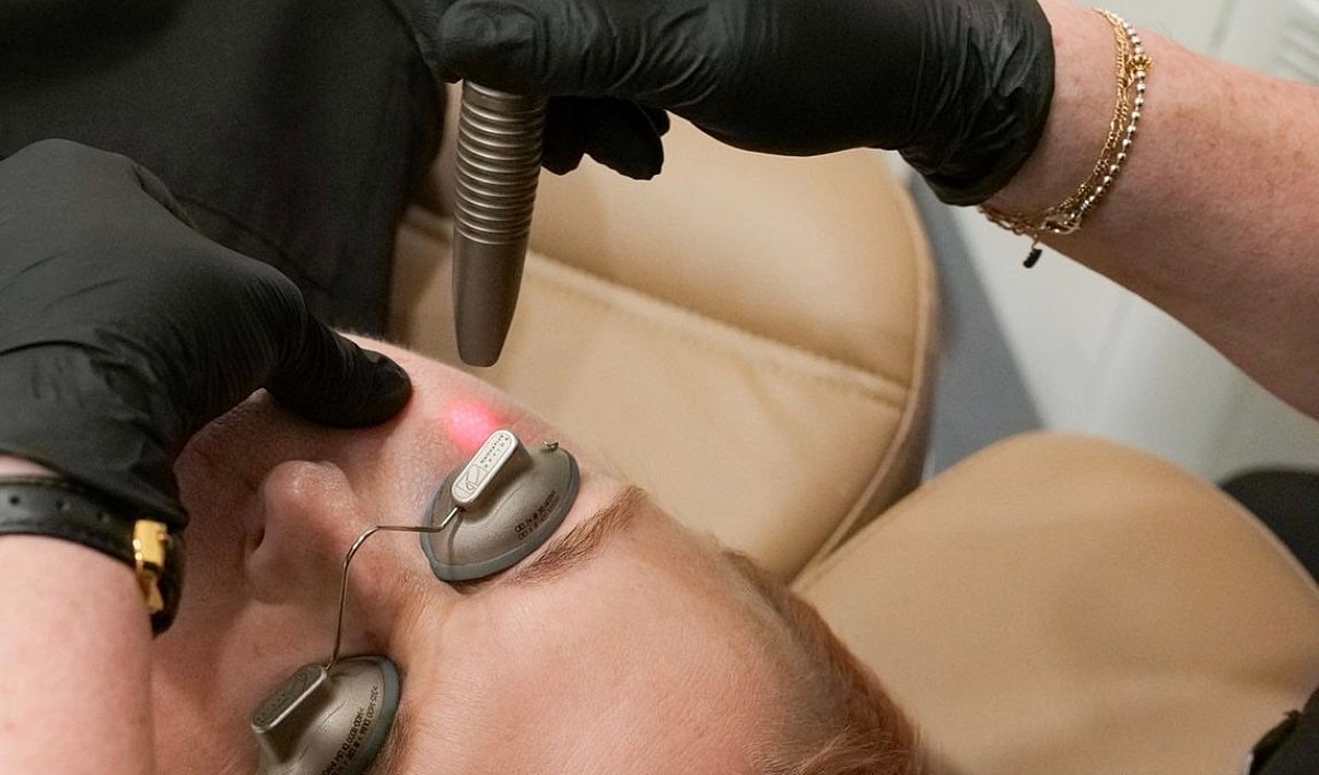 Laser treatment session on a person's face.