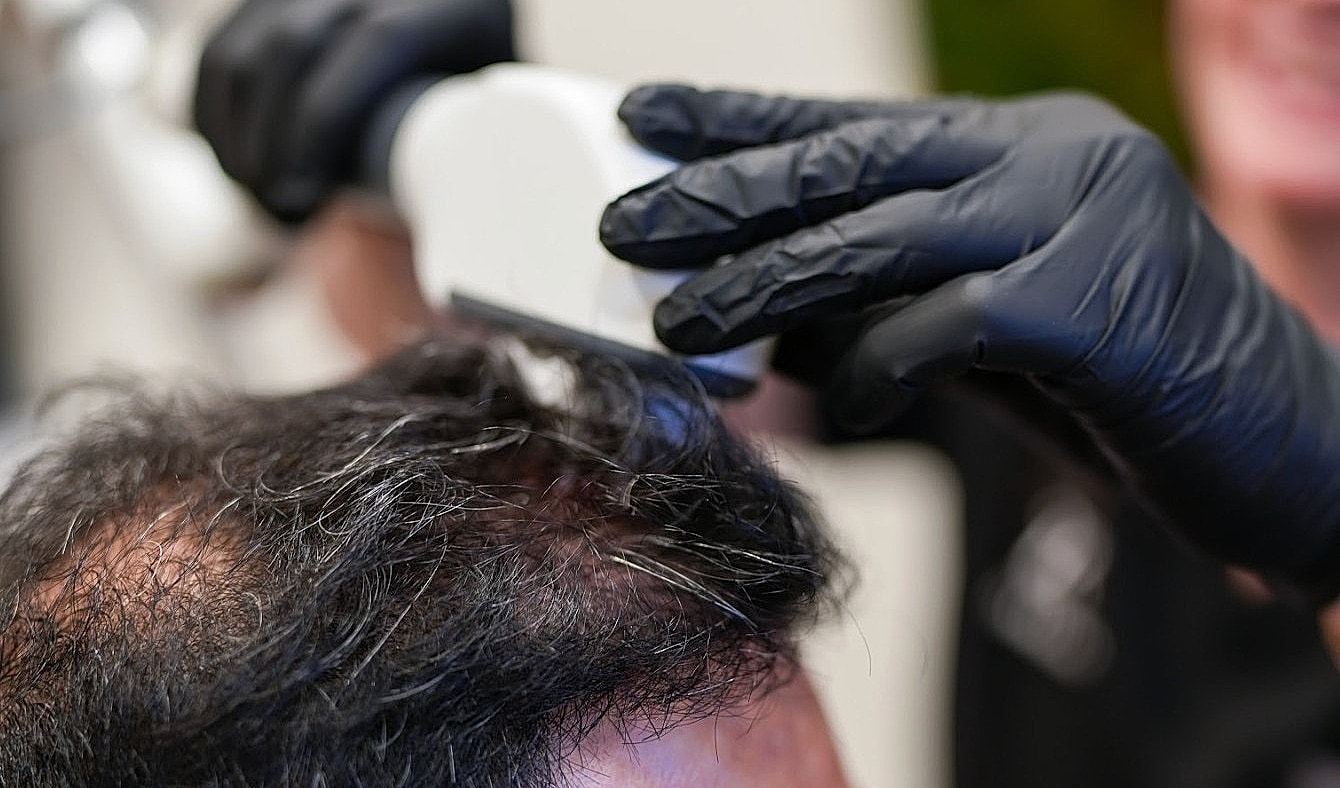 Scalp treatment using laser technology on patient.