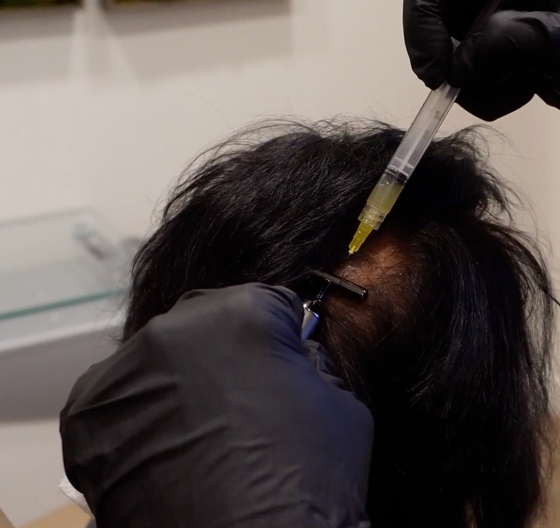 Applying treatment to scalp with syringe.