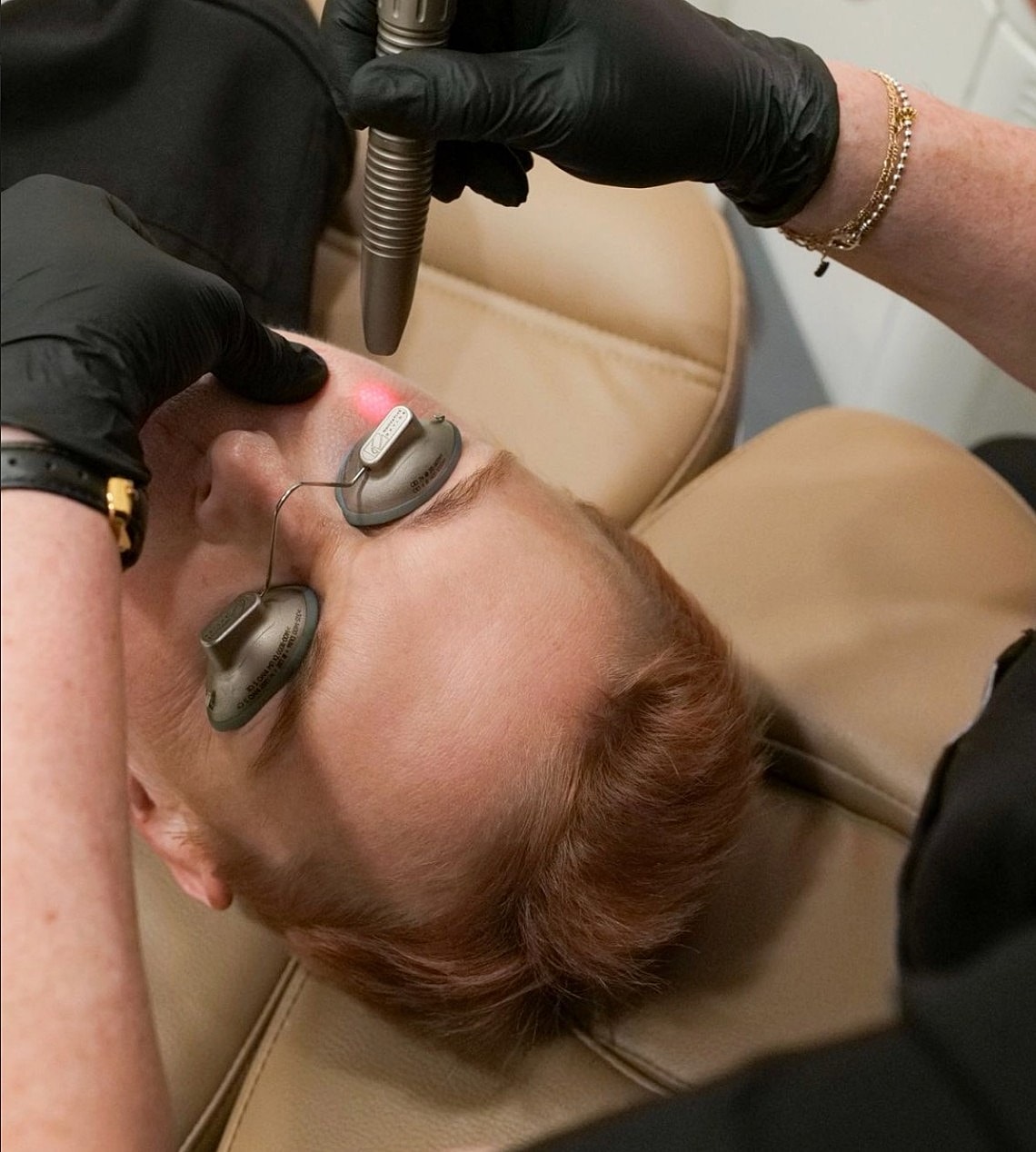 Facial treatment using a laser device.